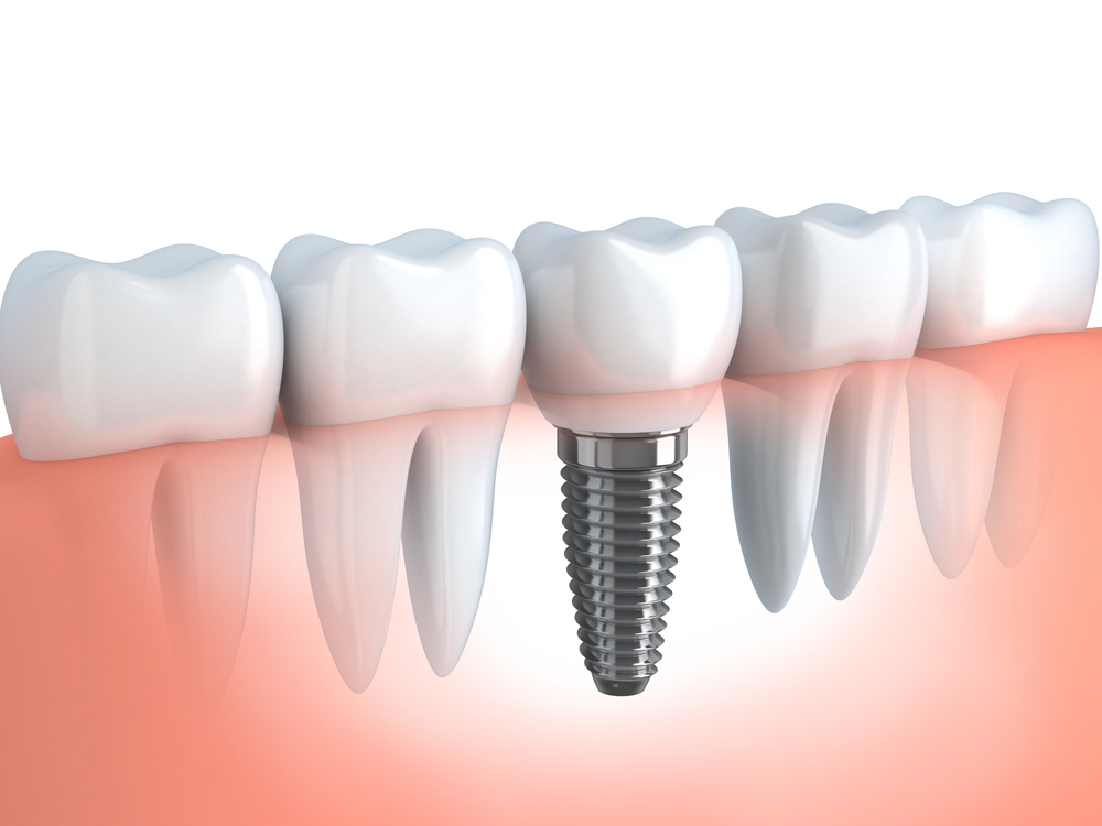 4 Things You Should Know About Getting Dental Implants